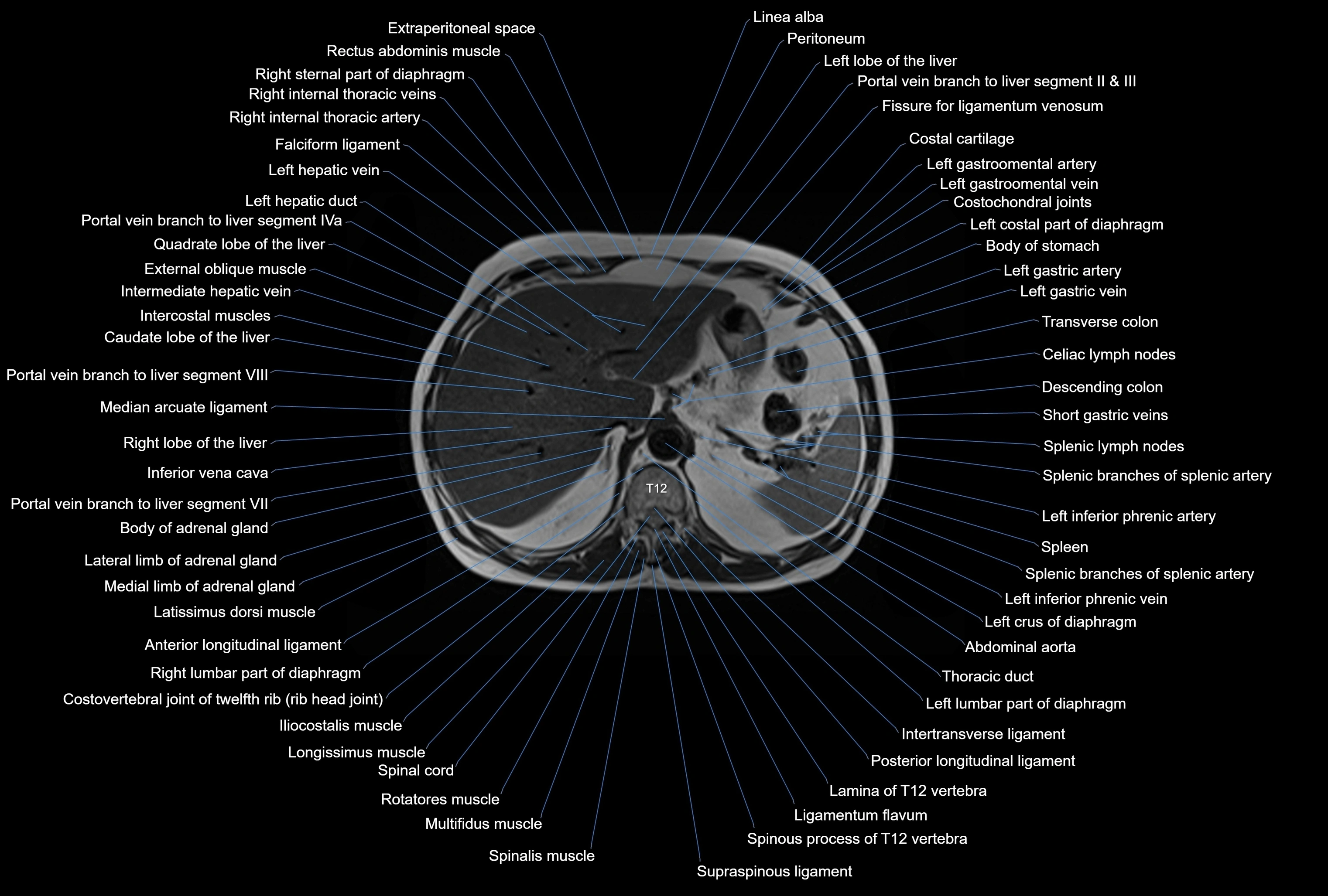 MRI Abdomen axial cross sectional anatomy radiology  image-img-00001-00012.webp